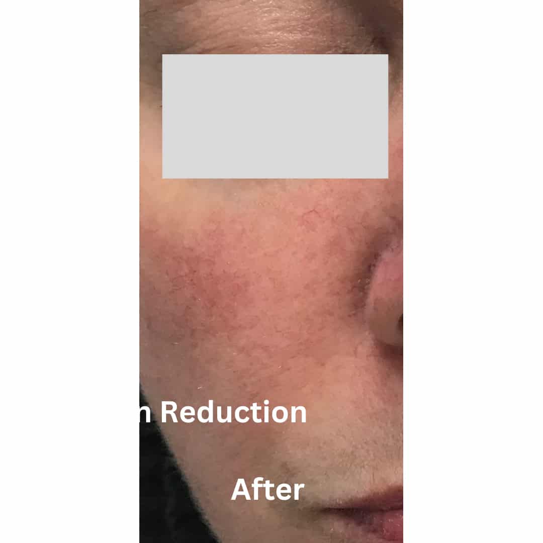 After Image: Laser Vein Reduction - front