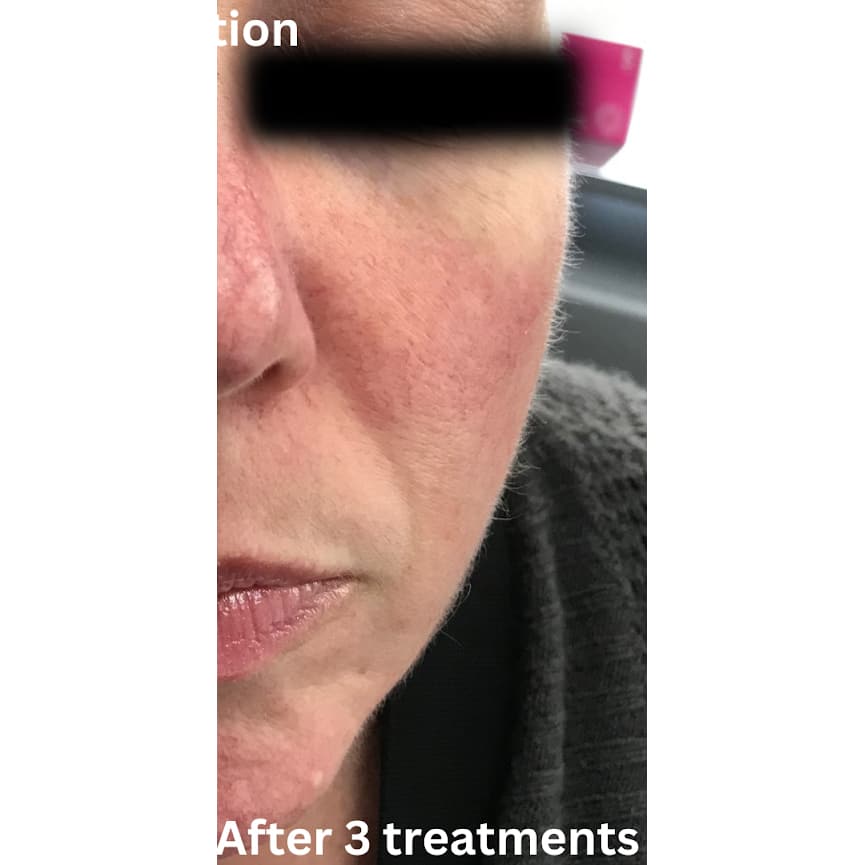 After Image: Laser Vein Reduction - front