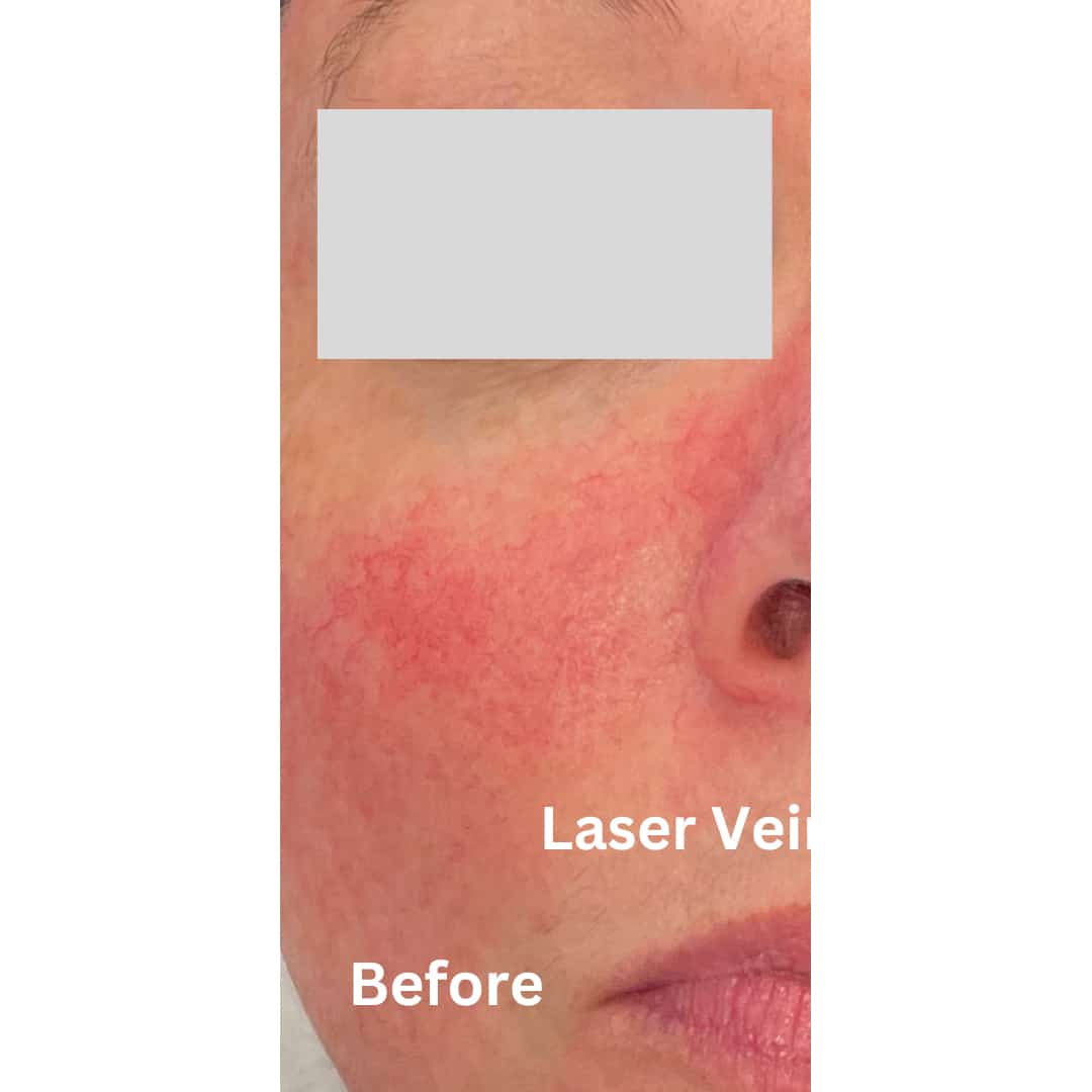 Before Image: Laser Vein Reduction - front