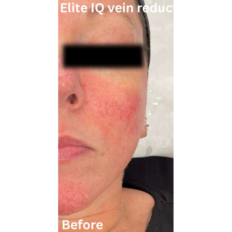 Before Image: Laser Vein Reduction - front