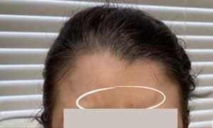 Botox